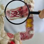 Crohn e retocolite avançam no Brasil, aponta estudo