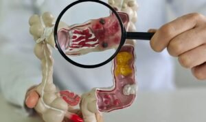 Crohn e retocolite avançam no Brasil, aponta estudo