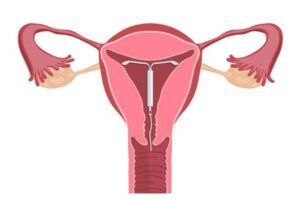 DIU hormonal passa a ter cobertura obrigatória para casos de endometriose