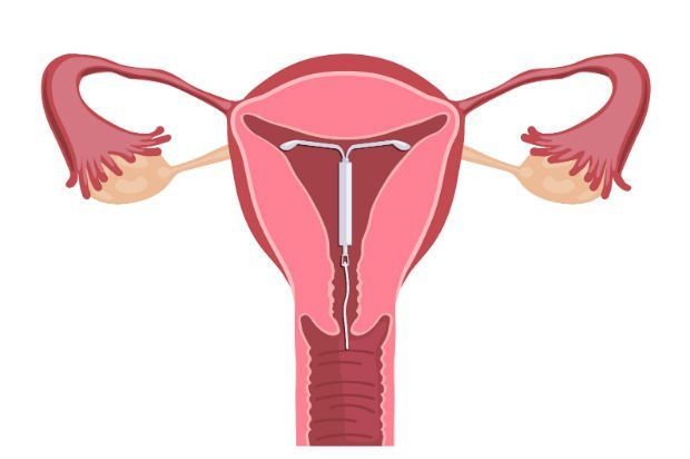 DIU hormonal passa a ter cobertura obrigatória para casos de endometriose